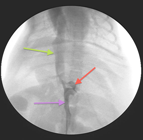 Intraoperative fluoroscopy (portovenogram) 